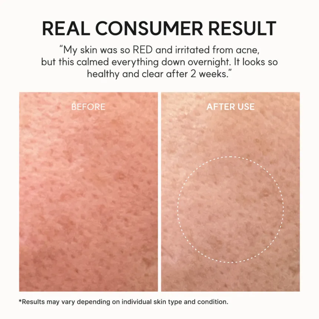 Eraser Soothing Cream